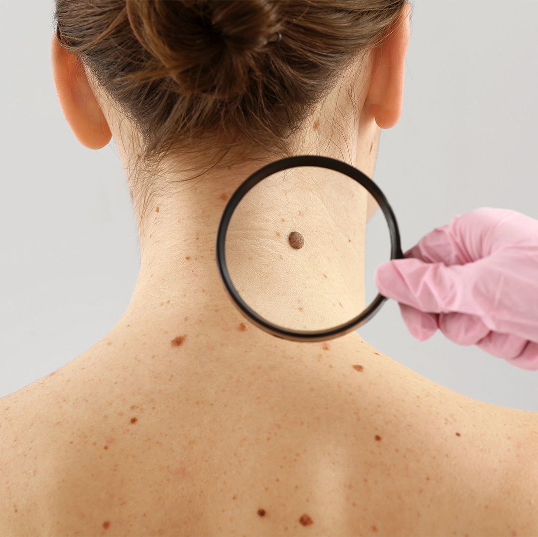 Benler Ne Zaman Risklidir? ABCDE Kuralı Nedir?