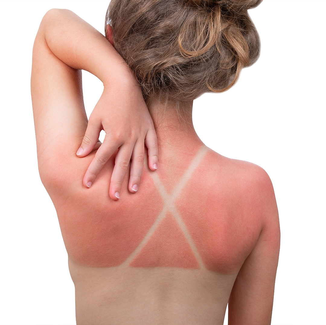 Güneş Yanığı Nedir ve Evde Yapılan Hatalar Nelerdir?