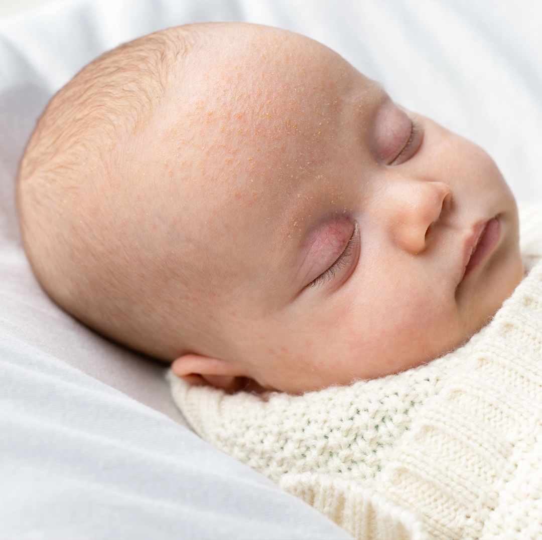 Bebeklerde Konak (Seboreik Dermatit) Nedir?