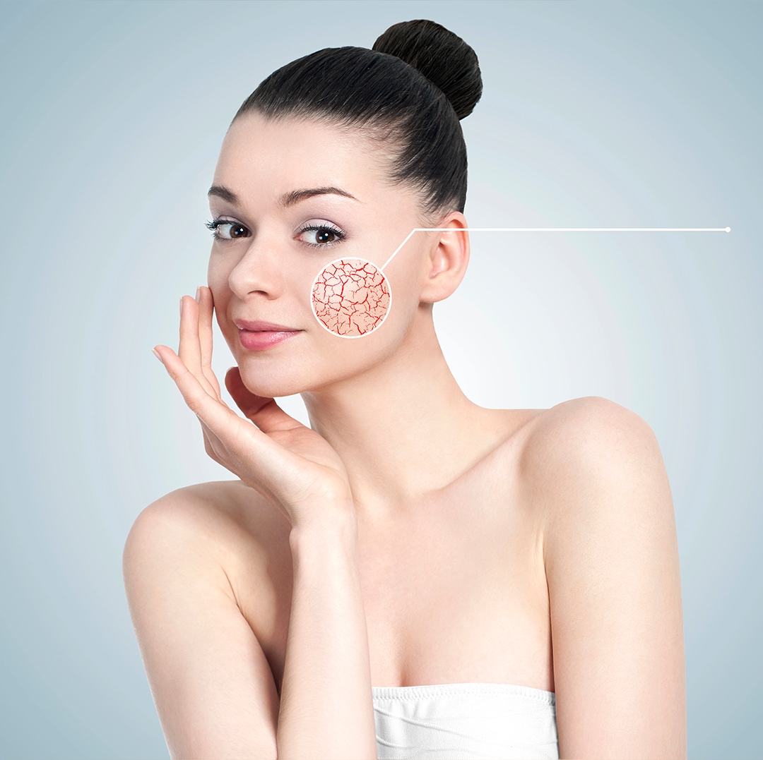 Ciltte İnce Kılcal Damarlar Neden Belirginleşir?