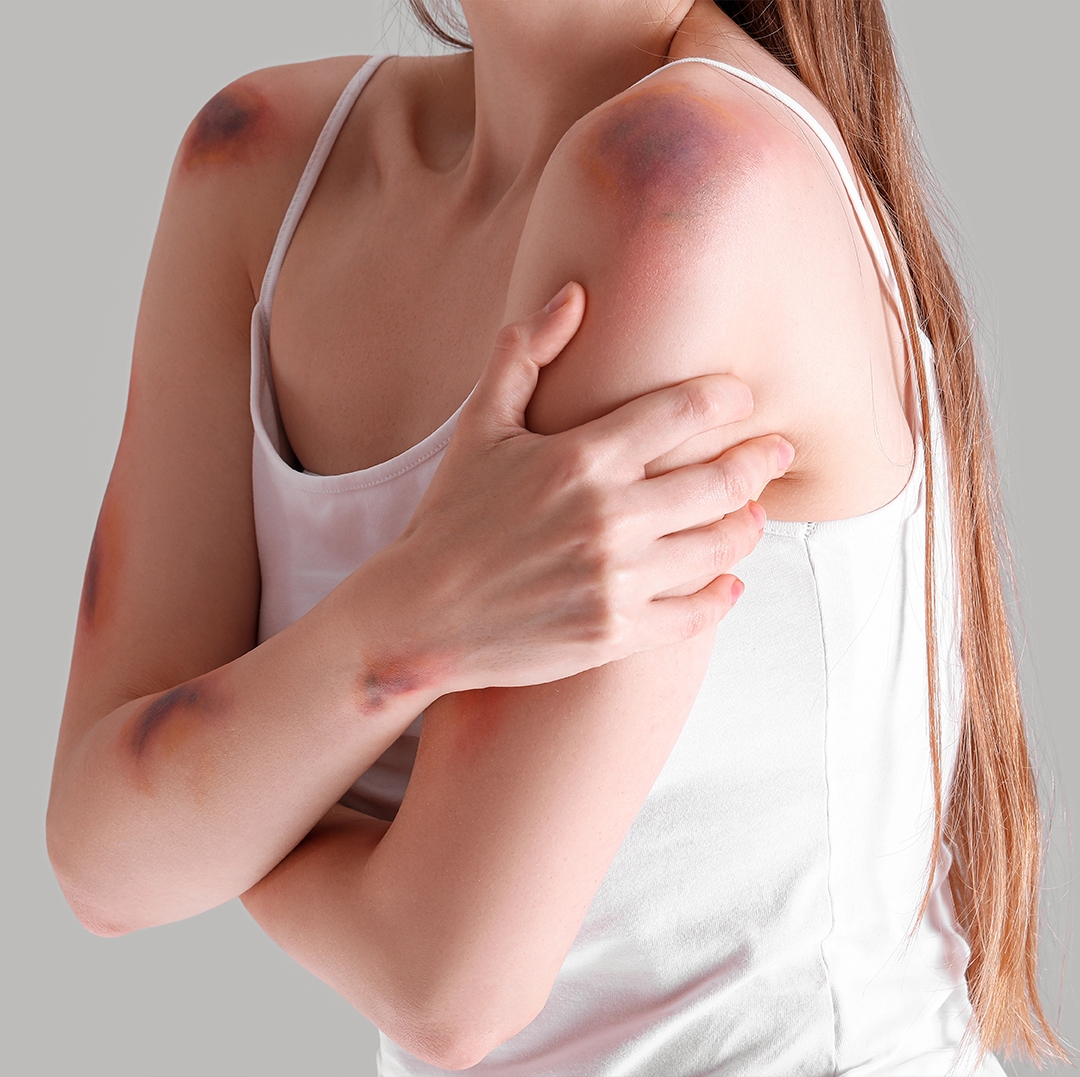 Ciltte Morarma (Hematoma) Neden Olur ve Ne Zaman Tehlikelidir?