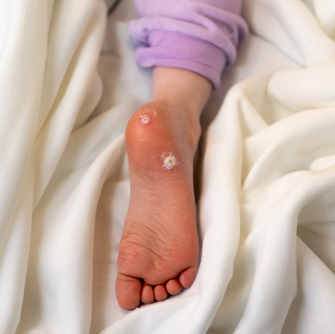 Çocuklarda Siğil Neden Daha Sık Görülür?